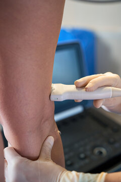 Detailed ultrasound examination of a female leg conducted by a doctor to diagnose and map areas of venous insufficiency