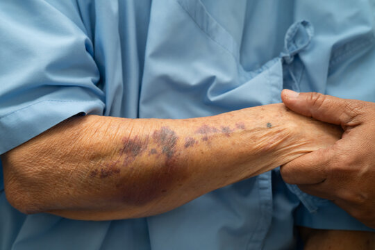 Ecchymosis, elderly bleeding on her arm after taking aspirin.
