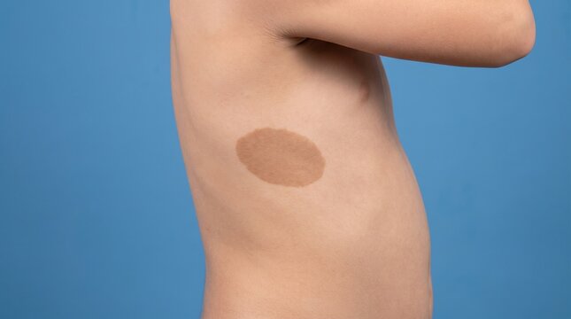 Side view profile of boy torso with a large flat caf�� au lait birthmark spot