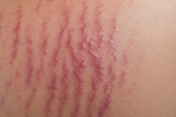 Fototapeta premium Close-up of red stretch marks on light skin showing texture and irregular pattern detail