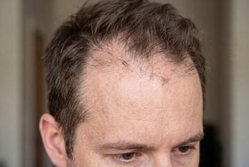 Fototapeta premium Focus on a frontal hairline with thinning hair. The person appears concerned about hair loss. This situation likely arises during daily life, indicating a real concern