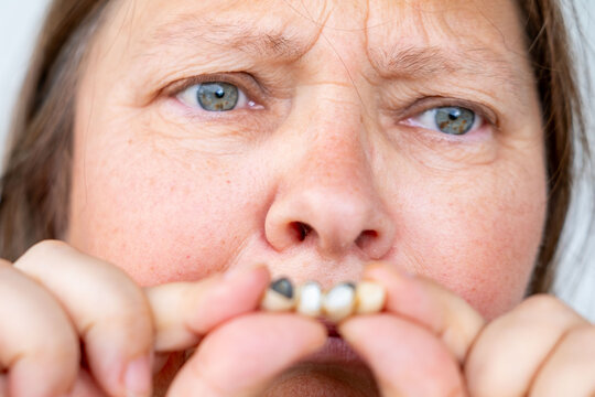 woman holding detached dental bridge next open mouth, decayed damaged teeth underneath, neglected oral hygiene, delayed checkups, broken crown prosthesis failure, need urgent prosthodontics treatment