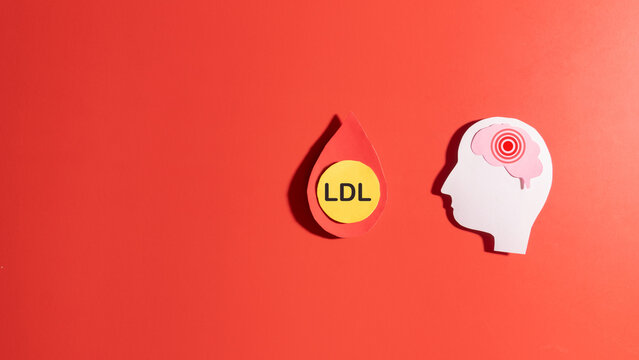 High LDL cholesterol increases the risk of stroke by boosting the risk of vascular disease. LDL cholesterol particles inside a blood droplet and human brain made from paper on red background.