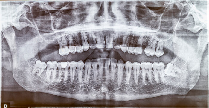 A wide panoramic dental radiograph (OPG), revealing a horizontally impacted lower wisdom tooth and a missing upper molar. The bony trabecular pattern and both temporomandibular joints (TMJ).