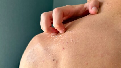 Fototapeta premium Man scratching peeling skin after sunburn. Close up of itchy sun damaged shoulder