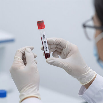 Expressionist Blood Analysis. A Laboratory Technician Holds A Blood Test Tube