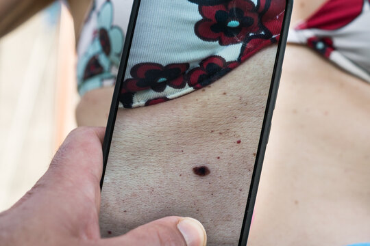 close up of a woman applying make upA person using a smartphone to photograph a dark nevus on a woman's torso to monitor for changes, promoting skin cancer awareness and prevention.