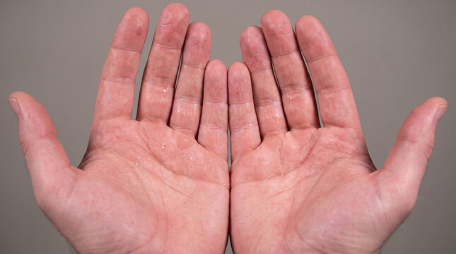 Close-up of sweating palms with hyperhidrosis showing excessive moisture and sweat droplets, palmar hyperhidrosis skin condition medical concept