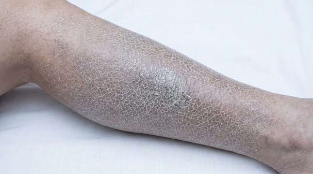 Leg skin with ichthyosis vulgaris showing fish scale pattern dry scaly skin grey white flakes, hereditary keratinization disorder dermatology concept