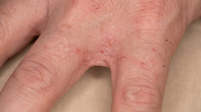 Close-up of hand with scabies showing burrow tracks papules and vesicles between fingers, parasitic skin infestation dermatology medical concept