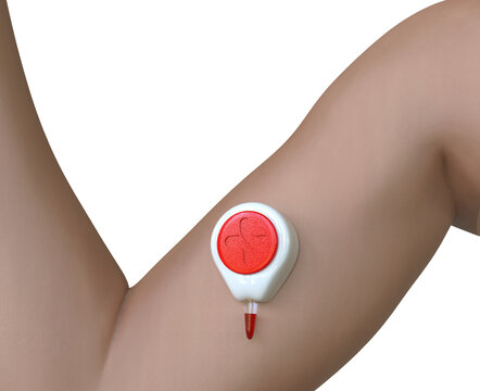 A Tasso Inc HemoLink device placed on a patient's arm for painless self-testing blood collection, isolated on white