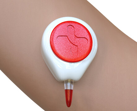 A Tasso Inc HemoLink device placed on a patient's arm for painless self-testing blood collection, isolated on white