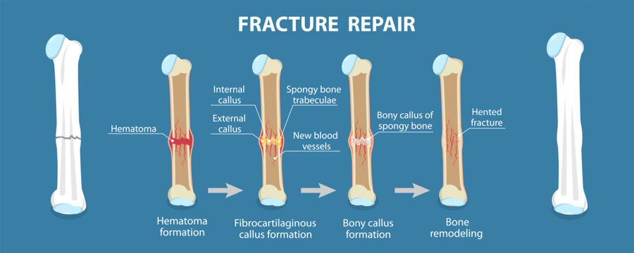 3D Isometric Flat Vector Illustration of Bone Repair Process, Remodeling And Formation Stages During Fracture Repair