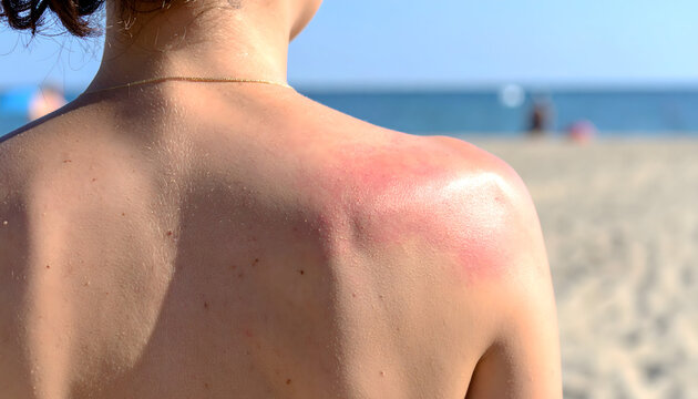 Sunburned skin on a young womans back after spending too much time under the bright summer sun at the beach