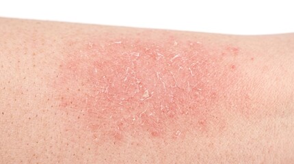 Fototapeta premium Close up of skin arm with a red scaly plaque from acute contact dermatitis