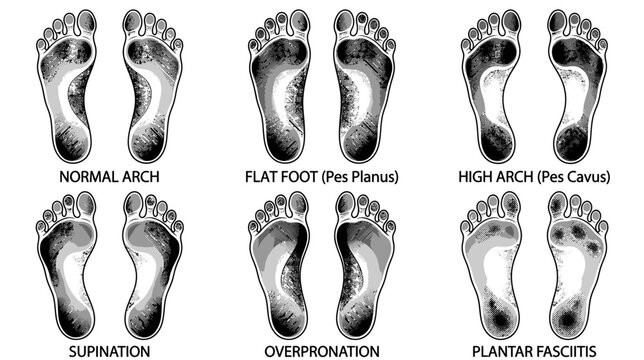 Foot Arch Types and Pronation Imbalances - Medical Illustration