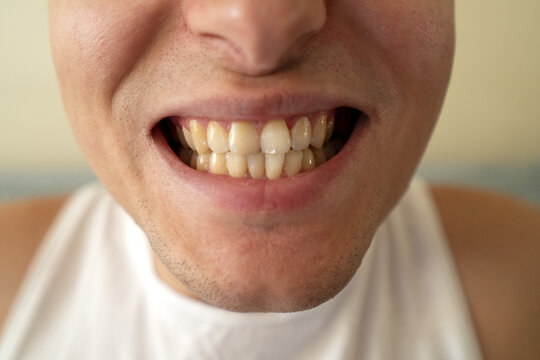 Man showing off his bright smile with healthy teeth and clear skin, conveying happiness and confidence in a casual setting.
