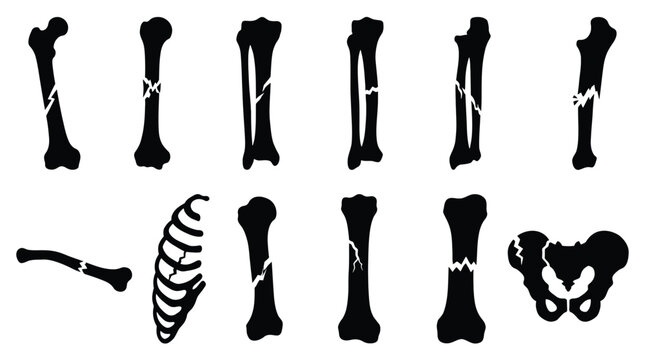 Set of broken bones silhouettes, vector illustration of different types of bone fractures, medical concept of skeletal injuries