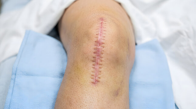 Close up of a stitched surgical knee scar.