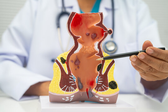 Asian doctor with rectum and hemorrhoid human model, inflamed vascular structure.