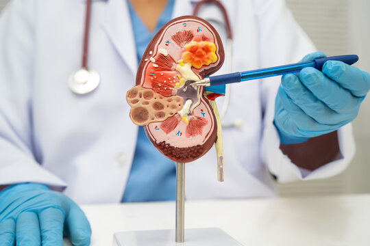 Chronic kidney disease, doctor with model for treatment urinary system, urology, Estimated glomerular filtration rate eGFR.