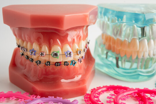 Orthodontic ligatures rings and ties, elastic rubber bands on orthodontic braces, model for dentist studying about dentistry.