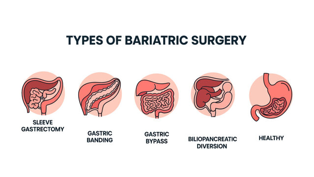 Bariatric Surgery Types Infographic with medical diagrams of gastric bypass and sleeve gastrectomy ideal for medical education and healthcare presentations.