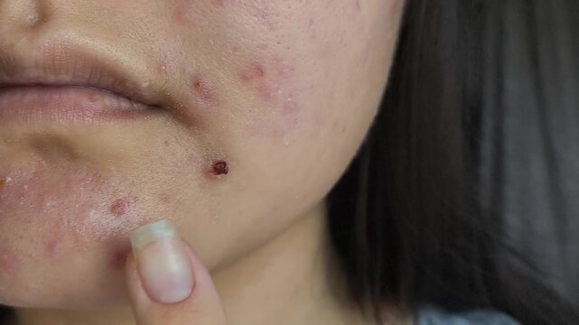 Teen girl with acne-prone skin, pimples, facial redness, skin imperfections and cosmetic dermatology concept.