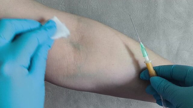 Nurse wipes the injection site on the arm vein with an alcohol cloth before intravenous infusion, venous access, infusion therapy and clinical healthcare concept.