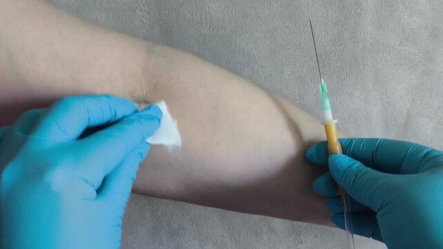 Nurse wipes the injection site on the arm vein with an alcohol cloth before intravenous infusion, venous access, infusion therapy and clinical healthcare concept.