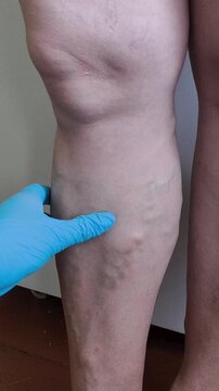 Close up of physician checking varicose veins, venous insufficiency, leg examination and healthcare concept.
