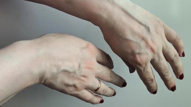 Medical professional checking arm veins, vascular examination, phlebology, circulation and healthcare concept.