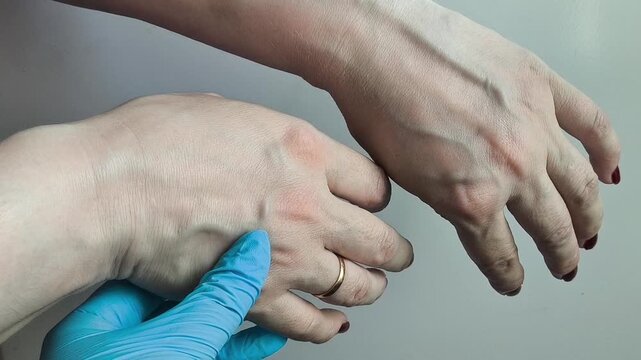 Healthcare professional examining veins on patient's arm, vascular examination, vein assessment and cardiovascular health concept.