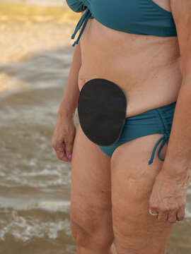 Woman with ostomy bag wearing bikini