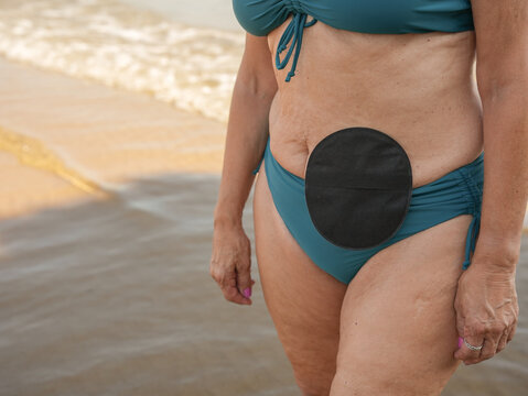 Colostomy bag in beach lifestyle