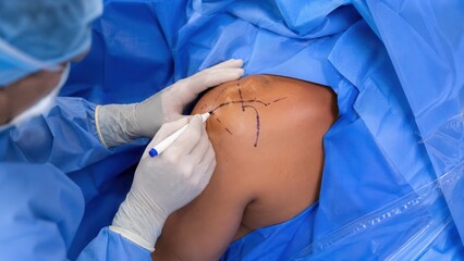 Fototapeta premium Surgeon marking shoulder joint before orthopedic surgery