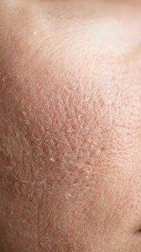 A close up view of dry skin with visible cracks and texture. The skin appears rough and lacks moisture, highlighting its condition
