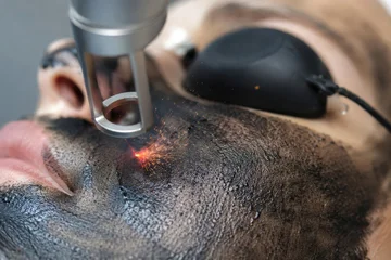 Woman receiving laser carbon facial treatment in cosmetology clinic. Cosmetologist using professional device to remove black mask for skin rejuvenation. Dermatological skincare procedure. © Anzhelika