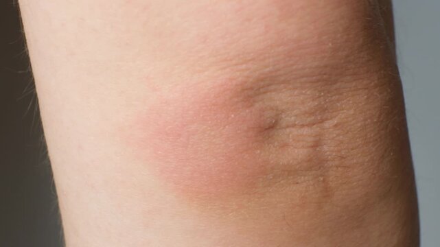 Erythema migrans rash caused by Lyme disease. Borreliosis symptom.