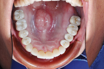 Intraoral macro photography of palatal torus bony growth on the maxilla hard palate. Dental examination of benign exostosis and oral pathology in human mouth dental cavity. © WIROT