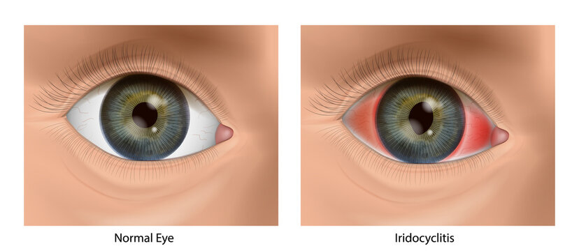 Iridocyclitis Eye Inflammation Comparison with Healthy Eye Medical Anatomy Illustration. Iridocyclitis Ocular Inflammation Educational Ophthalmology. Conjunctival hyperemia, inflammation