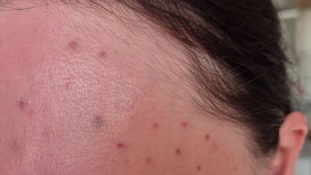 Close-up of an adult woman's forehead with injection marks and bruising after biorevitalization, cosmetic dermatology, post-procedure care, skin rejuvenation, treatment recovery
