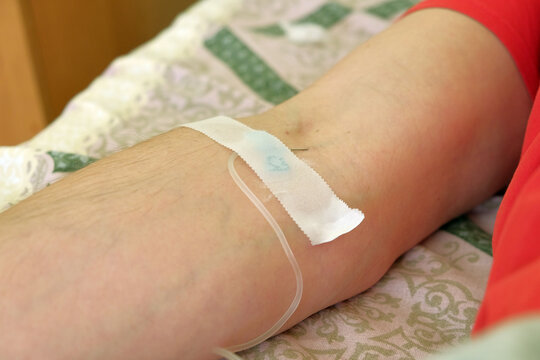 Close-up of a peripheral intravenous catheter inserted into a patient's arm, secured with medical tape and connected to tubing for hospital treatment, infusion therapy or hydration