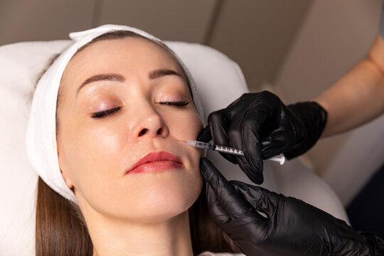 Filling of wrinkles, crow's feet, facial rejuvenation injection. Portrait of a white woman during surgery filling facial wrinkles, Cosmetic is injected into facial skin cosmetics