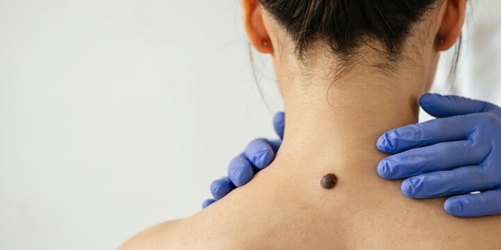 Dermatologist wearing blue gloves examining dark mole on patient neck skin.
