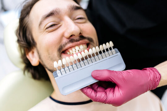 Dental shade guide used to select the ideal tooth color for a smiling patient. Concept dental veneers, cosmetic treatment, smile makeover, oral health, dentistry.