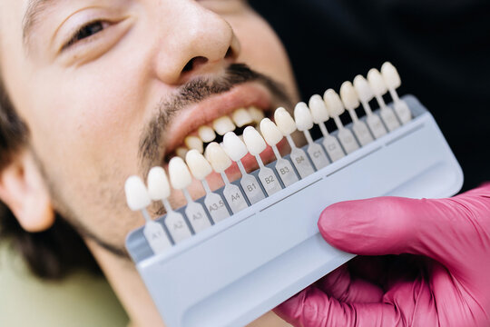 Dentist comparing tooth shades for a smiling patient in a modern dental clinic. Concept smile design, cosmetic dentistry, dental aesthetics, oral care, professional treatment.