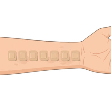 Flat vector illustration showing a patch test on a person's arm with six square patches placed in a straight line