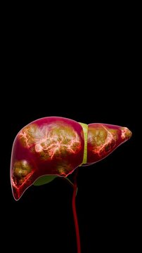 Fatty Liver Associated Liver Cancer Showing Tumor Angiogenesis, Cellular Growth, Tissue Invasion, Metabolic Dysfunction, and Progressive Hepatic Damage 3D Rendering
