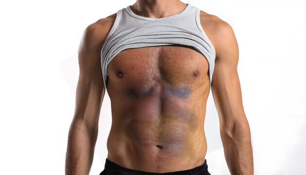 Frontal view of male abdominal contusion and ecchymosis from blunt force impact. Medical photography of soft tissue trauma on fit torso, white background.